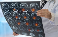 Ziua Mondială de Prevenire a Accidentului Vascular Cerebral