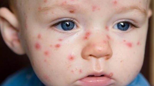 Read more about the article INFECȚIA ENTEROVIRALĂ